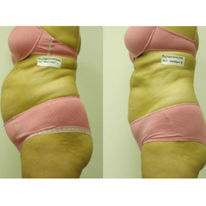 Liposuction & Body Shaping